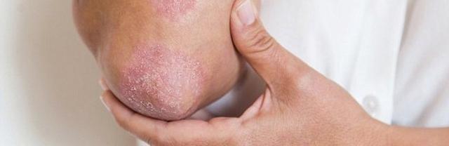 Tipos de Psoriasis