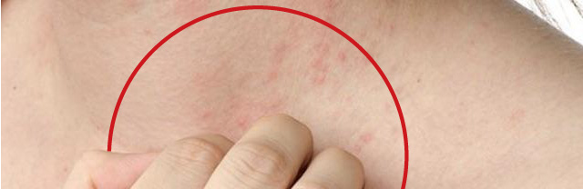 Investigadores hallan un posible nuevo enfoque contra la dermatitis atpica (interleucina-17).