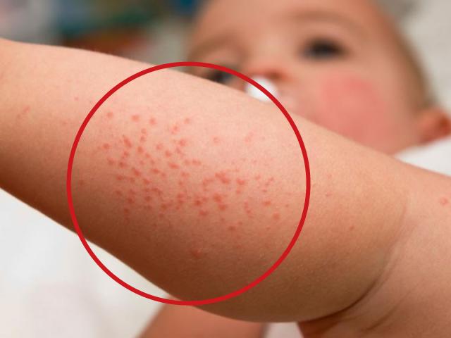 Dermatitis atópica, una afección de la piel que comienza en la niñez y causa molestias durante toda la vida