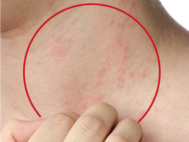 Investigadores hallan un posible nuevo enfoque contra la dermatitis atópica (interleucina-17).