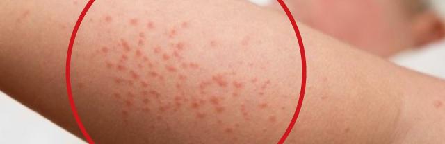 Dermatitis atópica, una afección de la piel que comienza en la niñez y causa molestias durante toda la vida